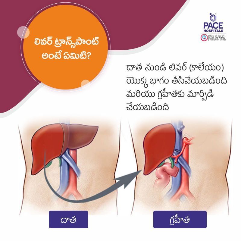 కాలేయ మార్పిడి అంటే ఏమిటి కాలేయ మార్పిడి అంటే ఏమిటి - Liver Transplant Cost in Hyderabad, India