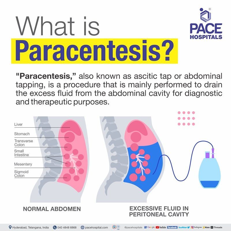 Best hospitals for paracentesis procedure in Hyderabad Best hospitals for paracentesis procedure in Hyderabad | paracentesis for ascites | abdominal paracentesis in Hyderabad, India | ascites tapping procedure in Hyderabad | paracentesis procedure near me
