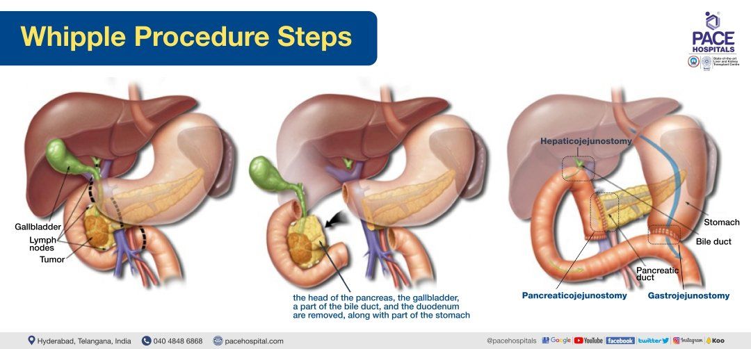 whipple procedure steps | whipples procedure steps | whipple surgery steps for whipple disease
