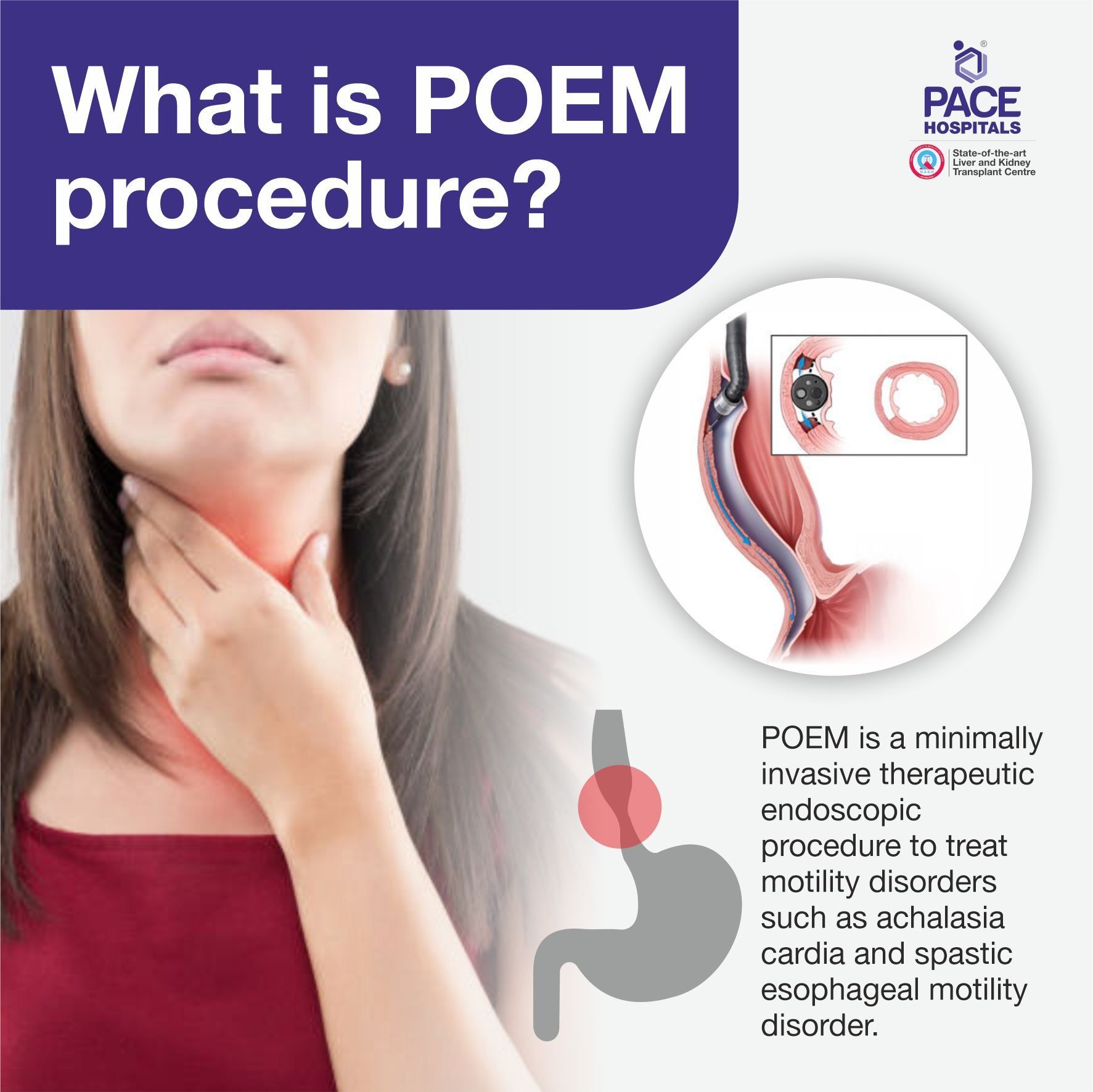 What is POEM procedure for achalasia cardia?