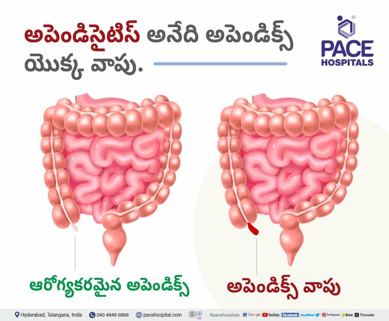 about appendicitis in telugu appendix meaning in telugu | appendicitis meaning in telugu | appendicitis telugu meaning | what is appendicitis in telugu