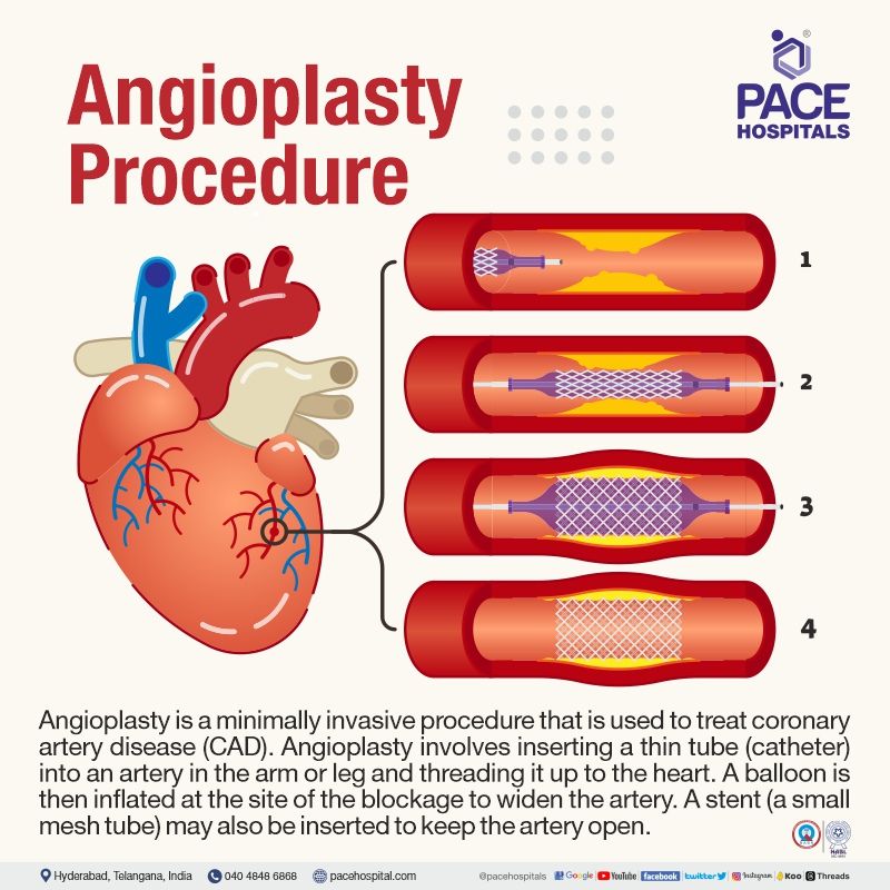 angioplasty procedure meaning what is angioplasty procedure | best angioplasty hospitals in hyderabad near me | angioplasty cost hyderabad telangana india
