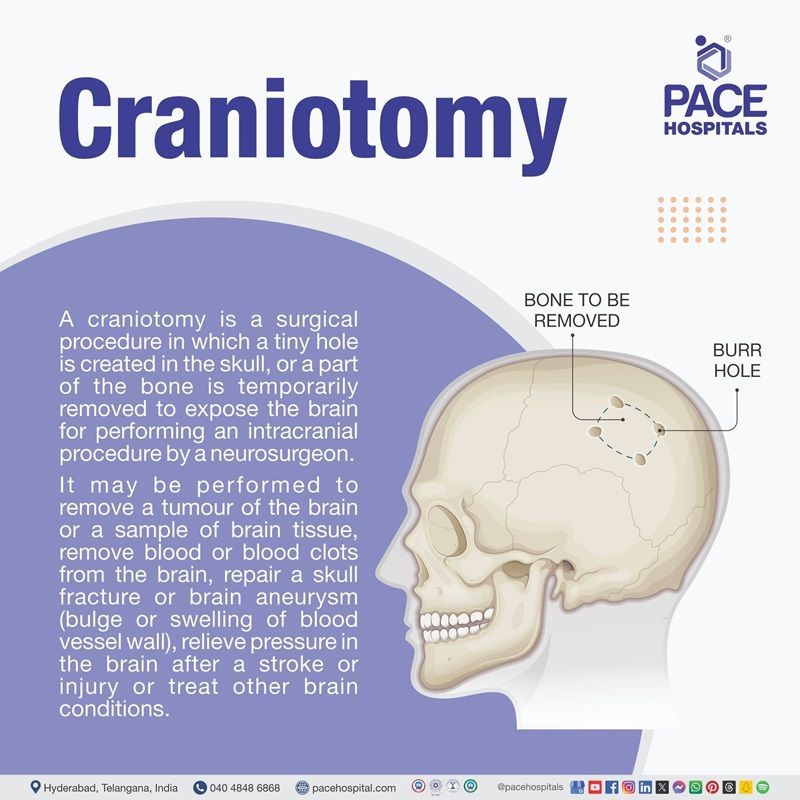 What is craniotomy procedure or surgery craniotomy surgery meaning | craniotomy procedure cost in Hyderabad, India | craniotomy definition | what is a craniotomy