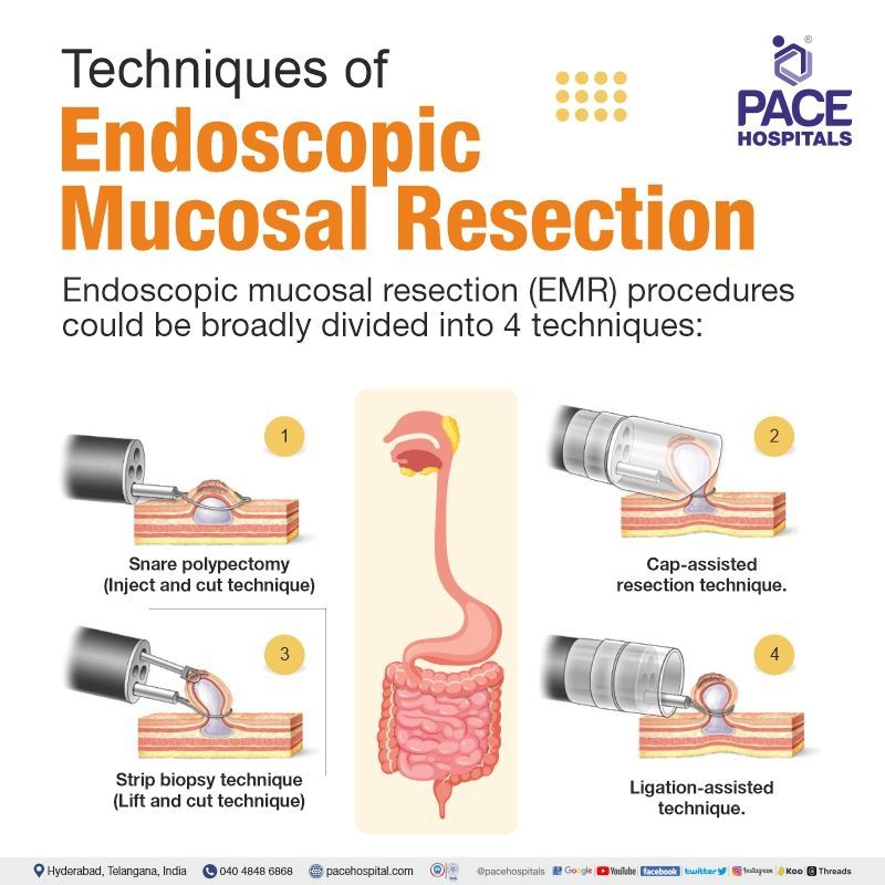 endoscopic mucosal resection procedure types endoscopic mucosal resection technique types | endoscopic mucosal resection cost | endoscopic mucosal resection near me | endoscopic mucosal resection procedure in Hyderabad, India | endoscopic mucosal resection colon polyps, barrett's esophagus
