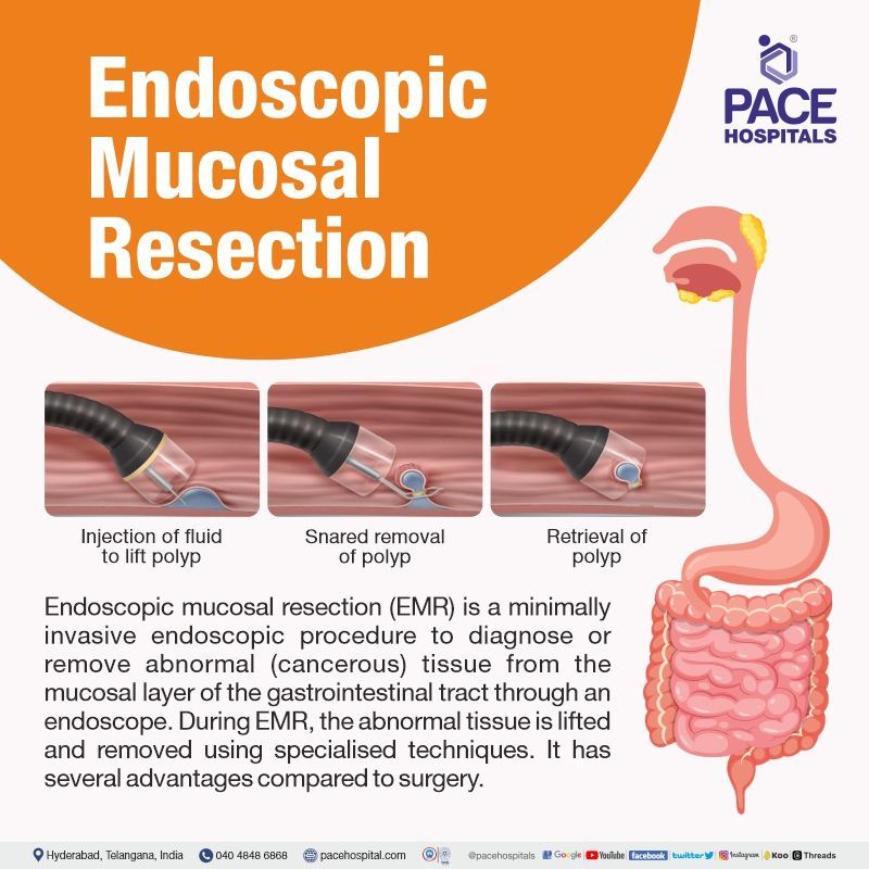 EMR procedure in Hyderabad, India | endoscopic mucosal resection colon polyps Endoscopic Mucosal Resection near me | what is EMR procedure | Endoscopic Mucosal Resection in hyderabad telangana | Endoscopic Mucosal Resection cost in India | endoscopic mucosal resection doctors