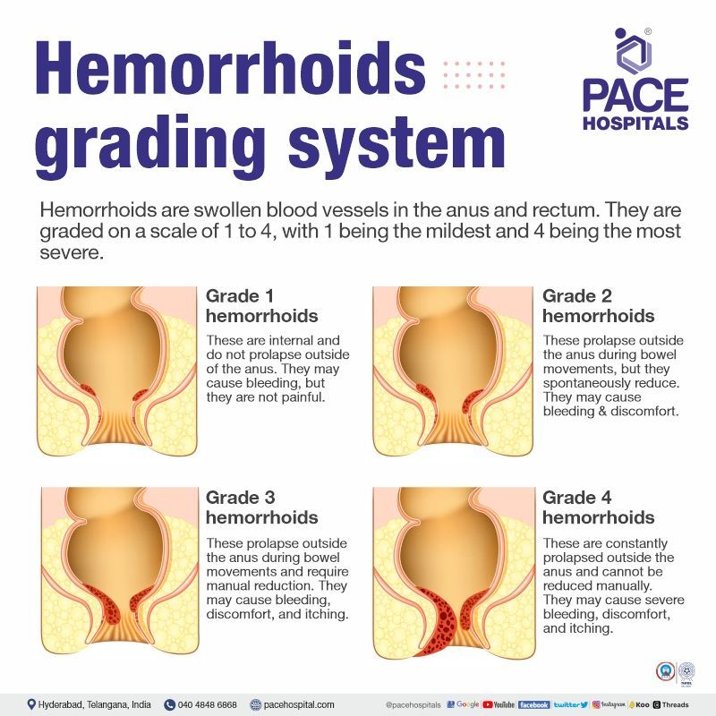 Grade 1,2,3, 4 piles treatment in Hyderabad, India types of piles | non surgical treatment for grade 1 piles | grade 2 & grade 3 piles treatment | laser treatment for grade 4 piles