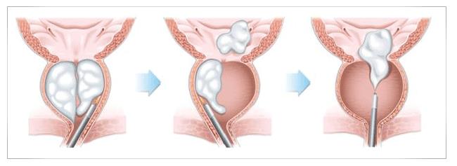 Holmium Laser Enucleation of the Prostate (HoLEP) Holmium Laser Enucleation of the Prostate (HoLEP) to treat an enlarged prostate (BPH)