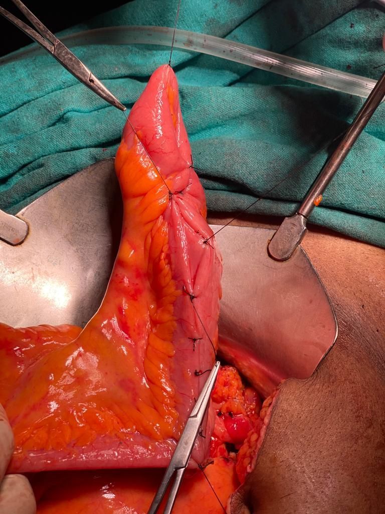 Laparoscopic total proctocolectomy and ileal pouch surgery at PACE Hospitals