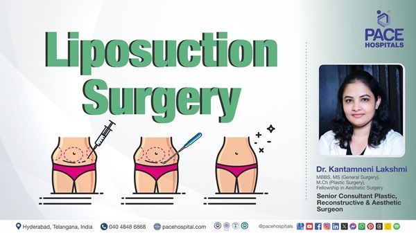 Video of Dr. Kantamneni Lakshmi from PACE Hospitals explaining liposuction procedure and benefits.