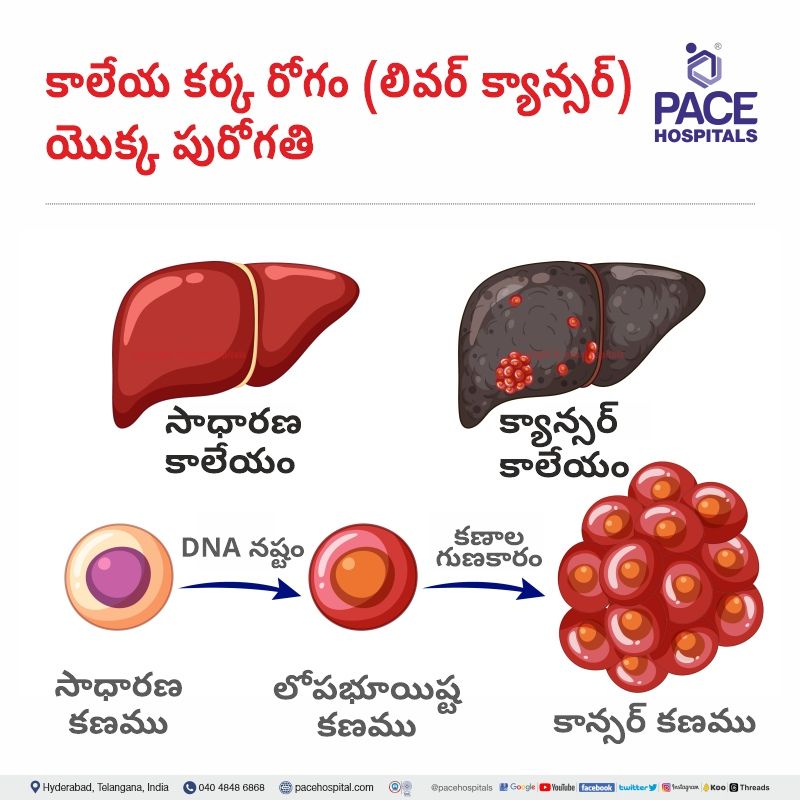 liver cancer in telugu కాలేయ కర్క రోగం (లివర్ క్యాన్సర్) liver cancer in telugu | liver cancer development in telugu | liver cancer meaning in telugu