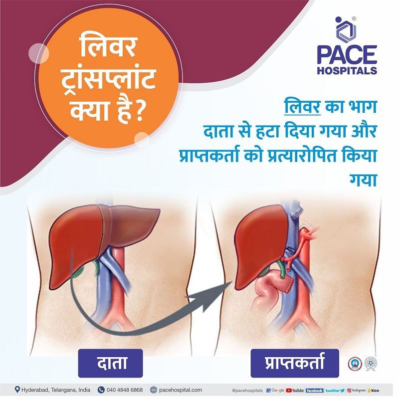 liver transplant meaning in hindi | what is liver transplant in hindi | liver transplant video in hindi | liver transplant in india in hindi