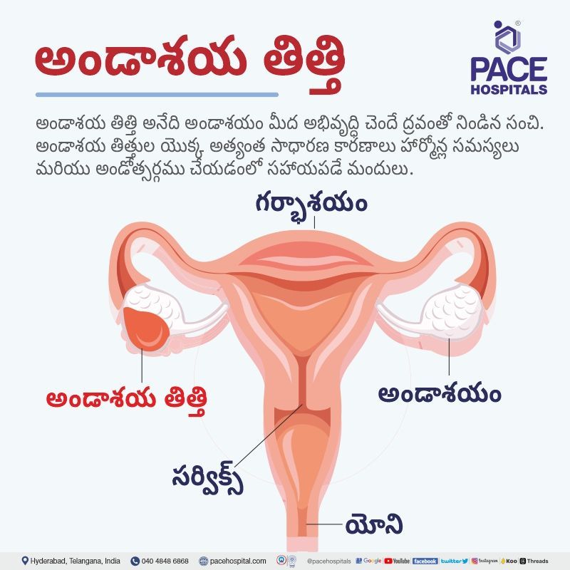 ovarian cyst telugu ovarian cyst meaning in telugu language | ovarian cyst in telugu language | ovary cyst in telugu language | about ovarian cyst in telugu | ovarian cyst telugu translation