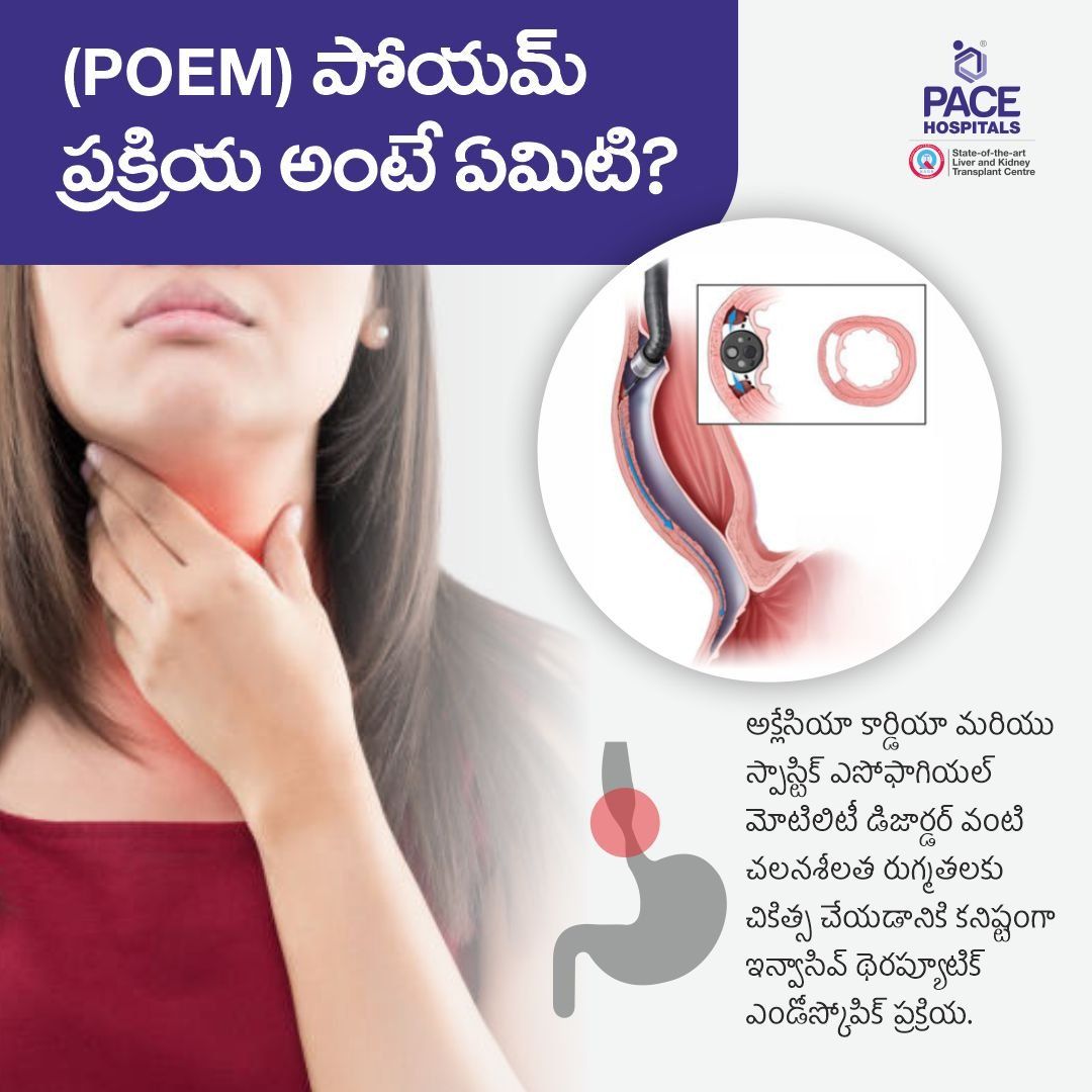 POEM for achalasia cardia in telugu poem surgery in telugu, poem procedure in telugu, peroral endoscopic myotomy (POEM) for achalasia cardia in telugu
