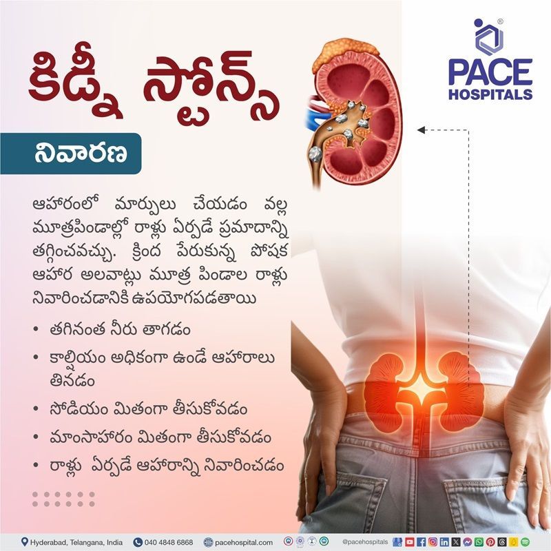 how to prevent kidney stones | kidney stone prevention | foods to prevent kidney stones | diet to prevent kidney stones | Visual narrating the preventive measures of Kidney stones
