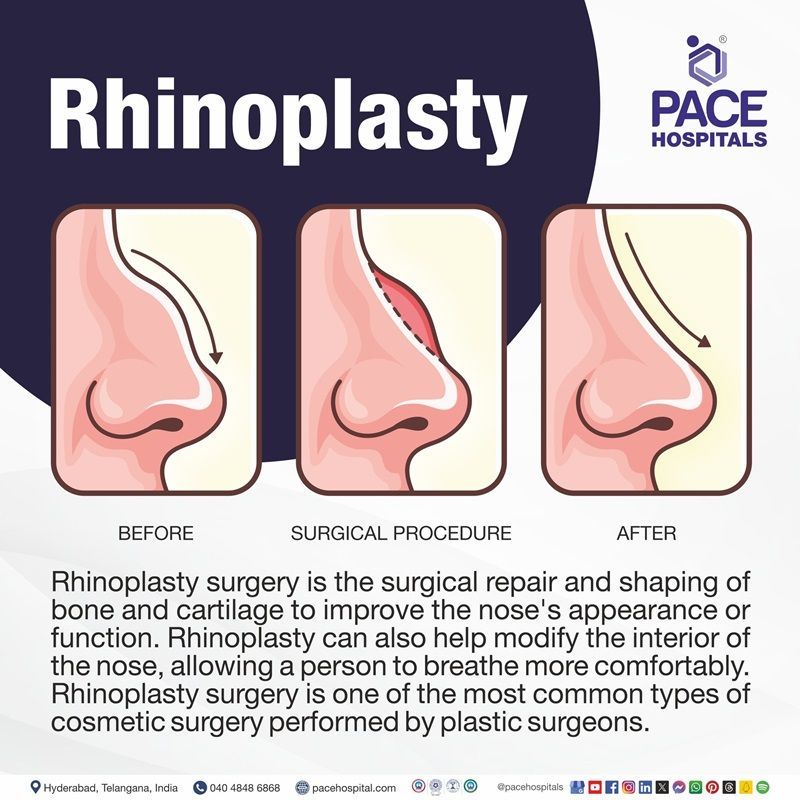 Rhinoplasty in Hyderabad | rhinoplasty before and after