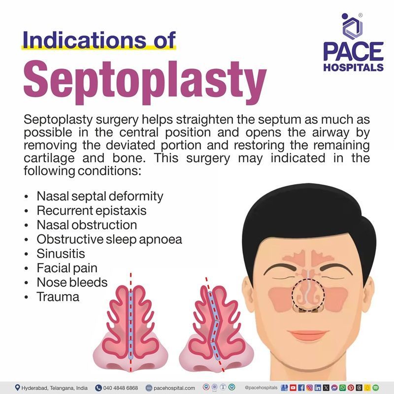 Indications of Septoplasty | Visual depicting septolpasty indications