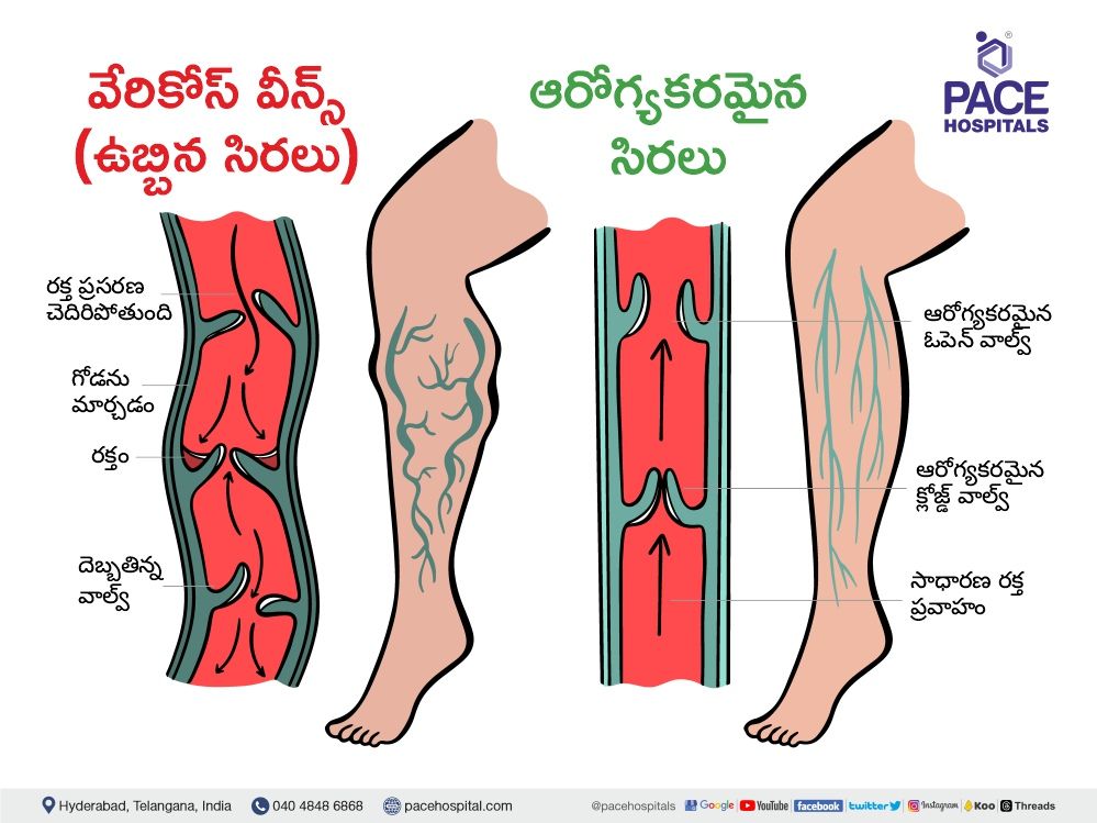 varicose veins in telugu | varicose veins meaning in telugu | about varicose veins in telugu | varicose veins telugu | varicose veins telugu meaning