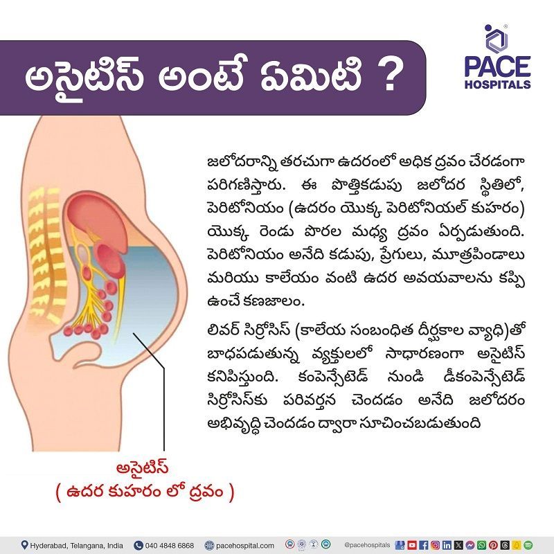 What is Ascites in Telugu? అసైటిస్ అంటే ఏమిటి? | What is Ascites in Telugu | ఏది అసిటిస్కు కారణమవుతుంది | అసిటిస్ వ్యాధి అంటే ఏమిటి | అసైటిస్ అర్థం | హైదరాబాద్లో అసిటిస్ చికిత్స