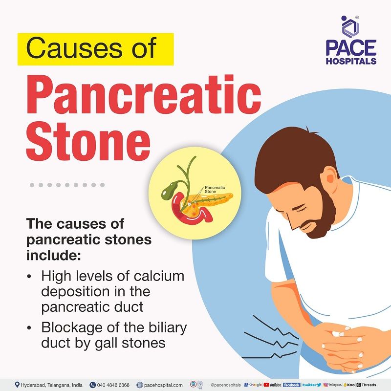Pancreatic stones Causes, Symptoms, Complications & Prevention