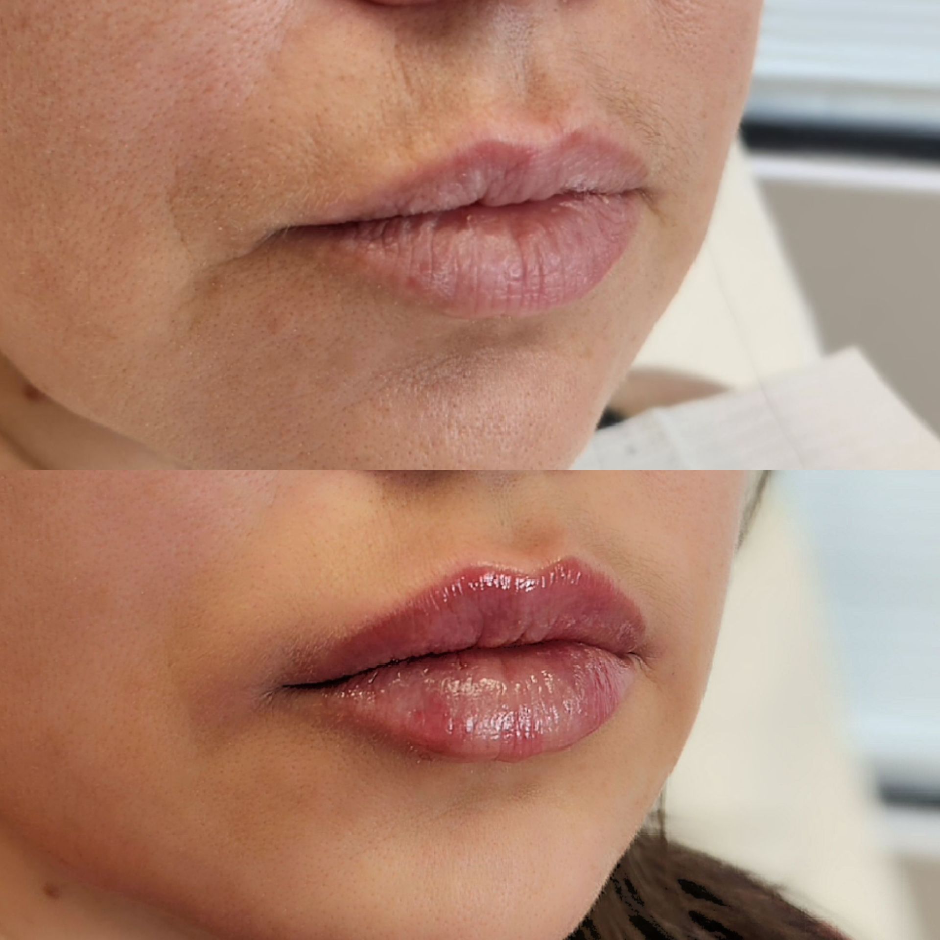 A before and after photo of a woman 's lips.