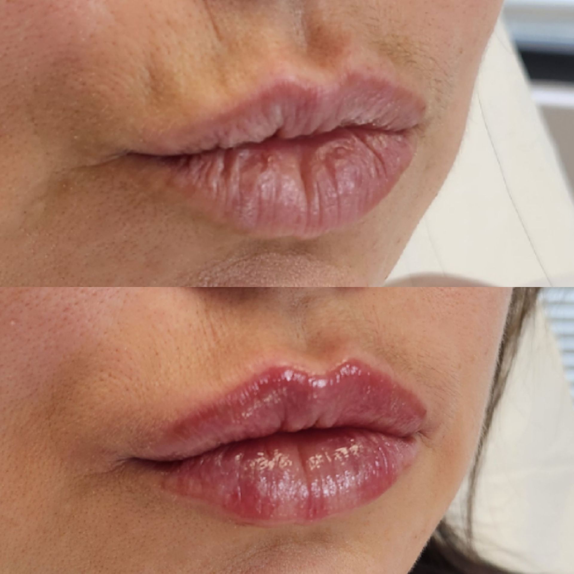 A before and after photo of a woman 's lips.