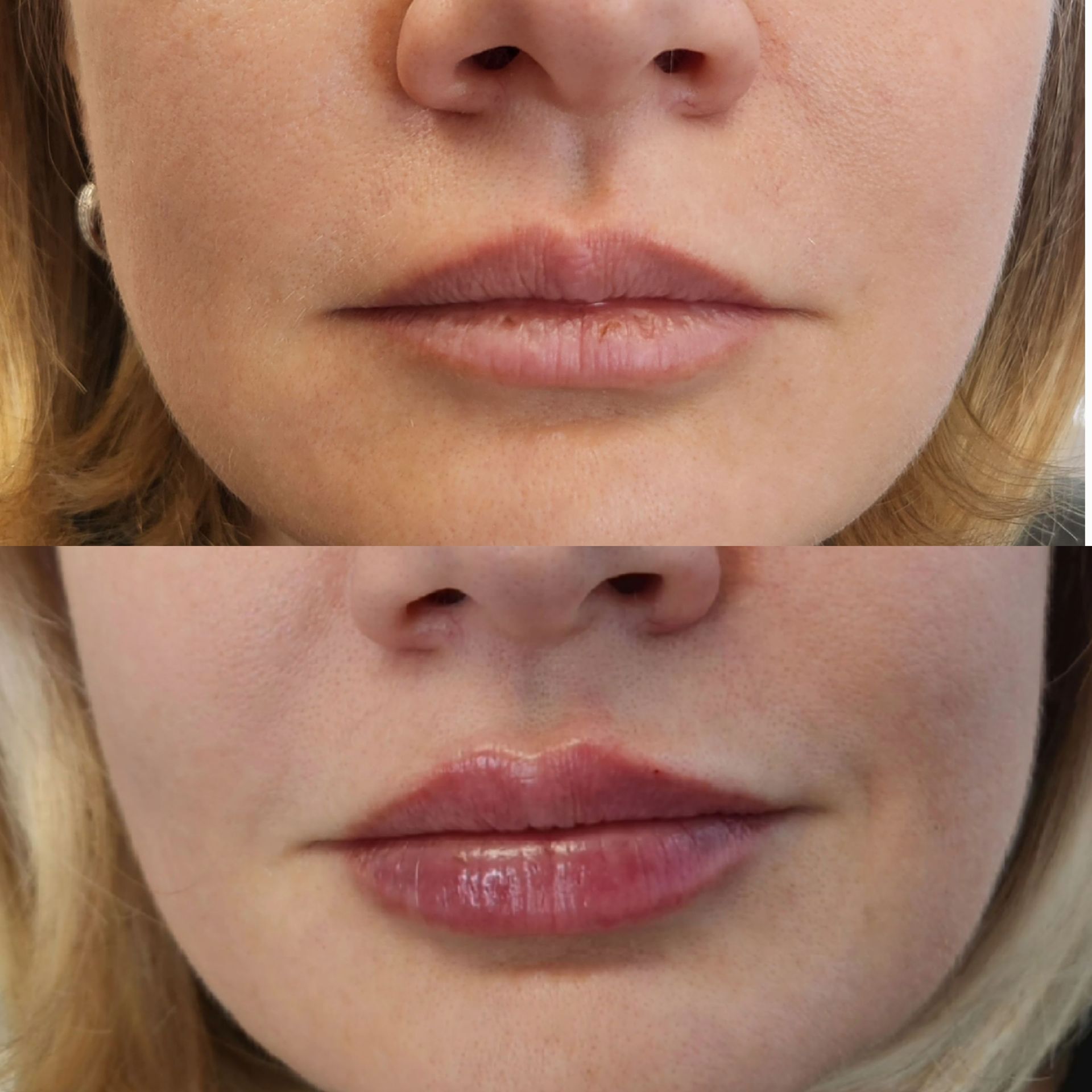 A before and after picture of a woman 's lips.