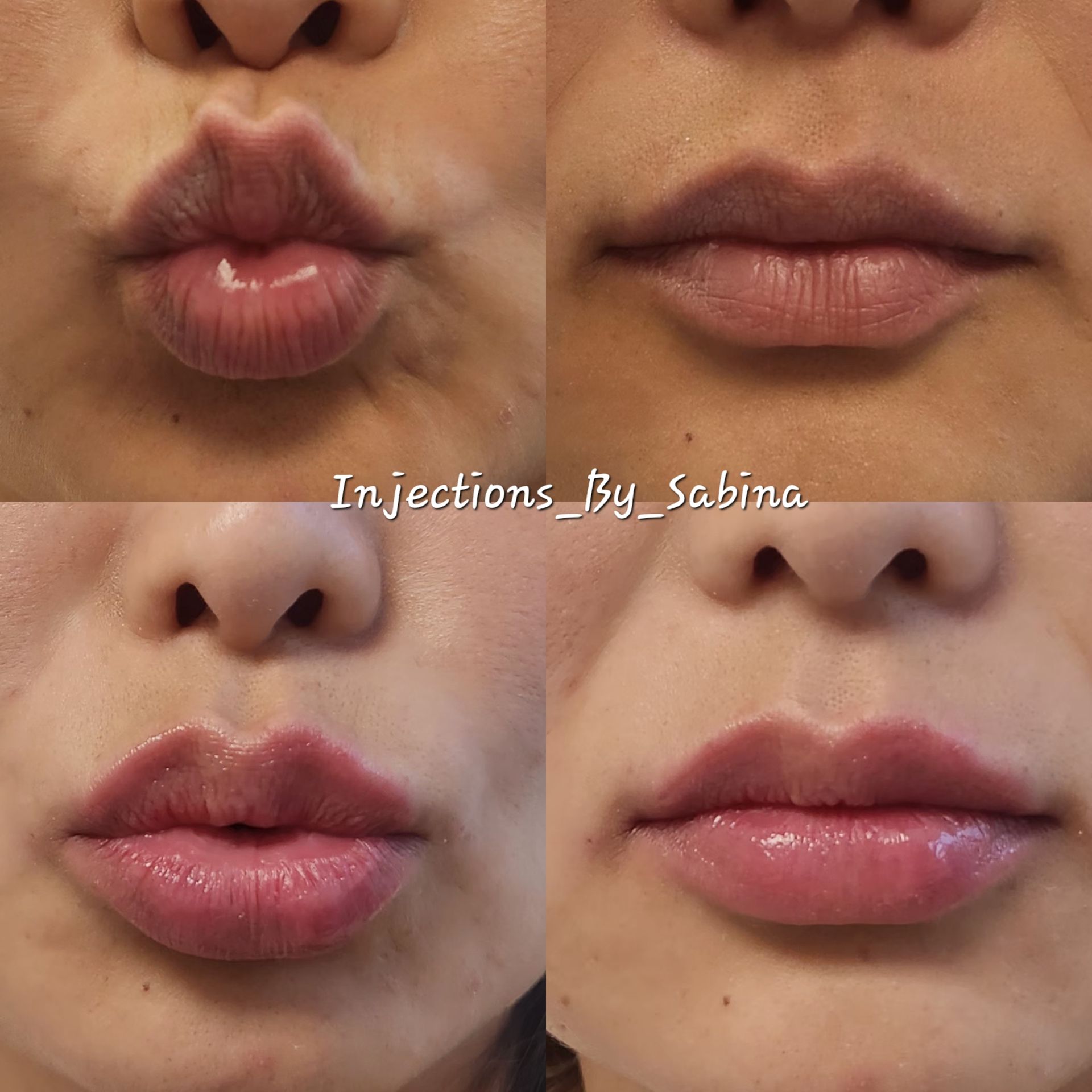 A collage of four pictures of a woman 's lips before and after injections by sabina
