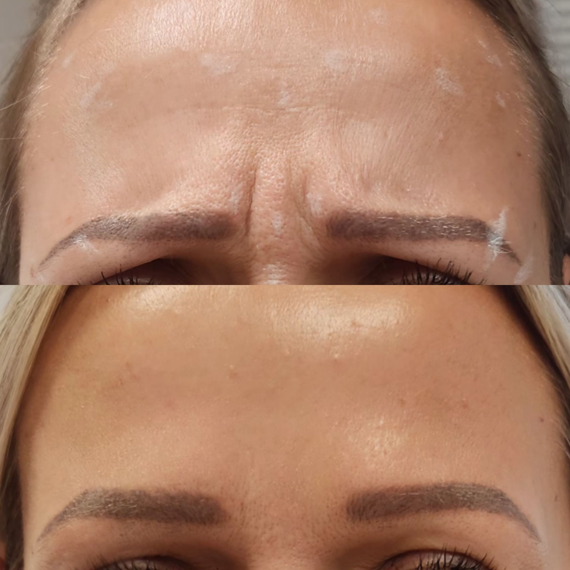 Top: woman's forehead with deep wrinkles. Bottom: same forehead, wrinkles smoothed after treatment.