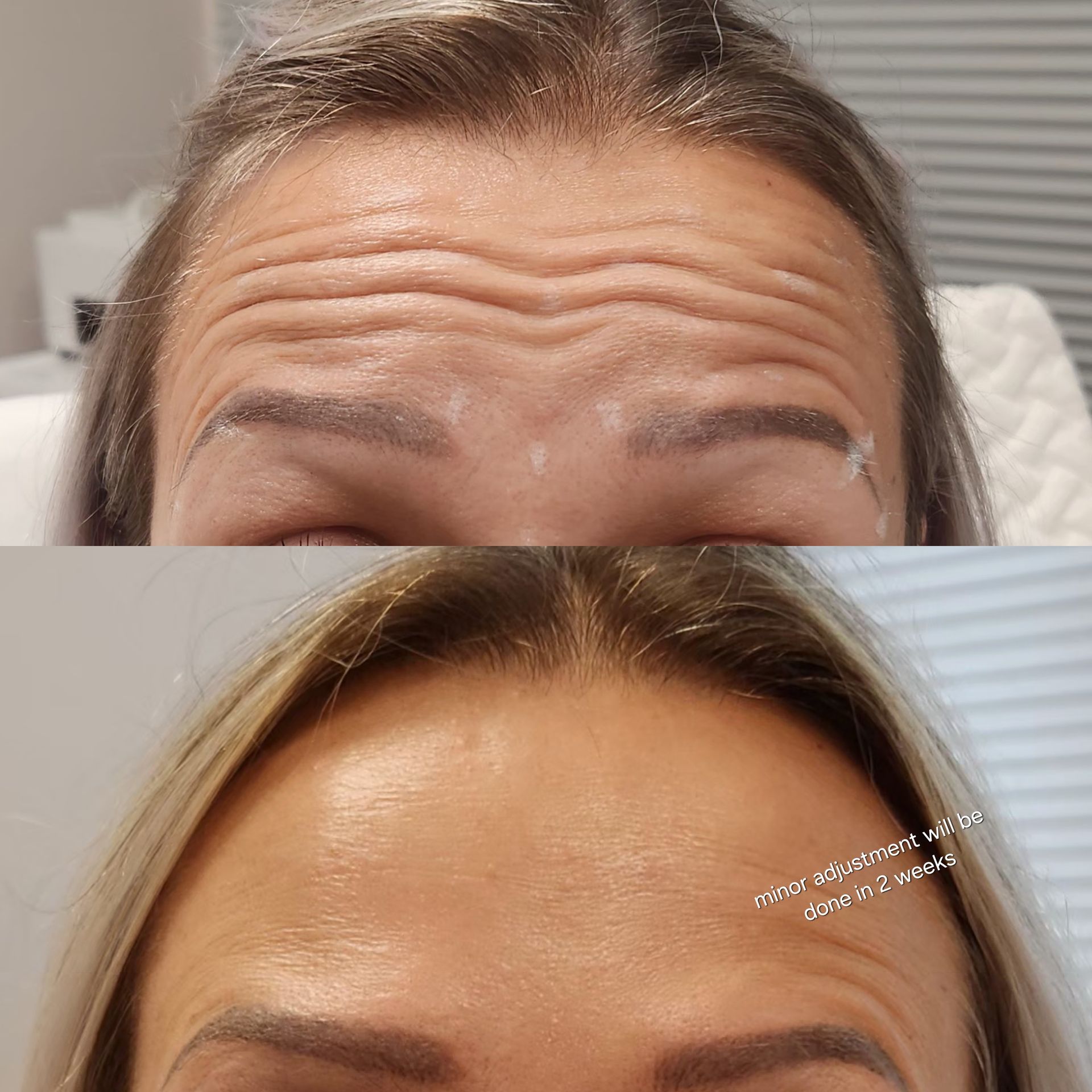 A woman 's forehead before and after botox injections.