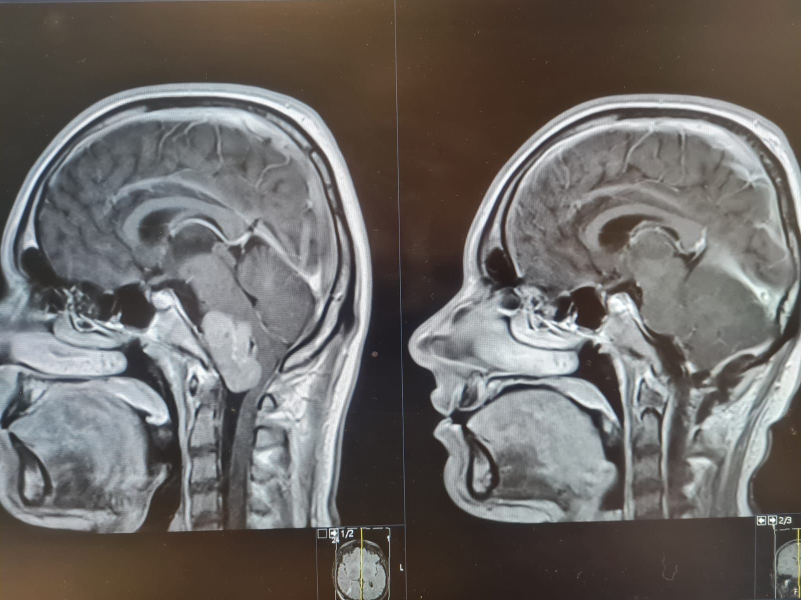 Surgical outcome
