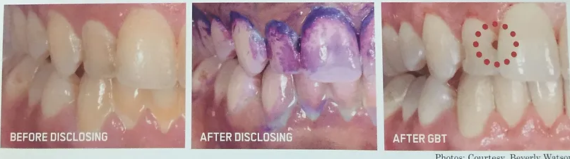 Caries Detection | Brisbane, QLD | Carina Dental Practice Caries Detection | Brisbane, QLD | Carina Dental Practice