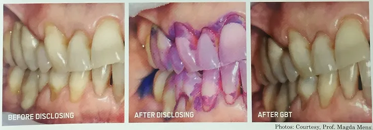 Exposed Dentine | Brisbane, QLD | Carina Dental Practice Exposed Dentine | Brisbane, QLD | Carina Dental Practice