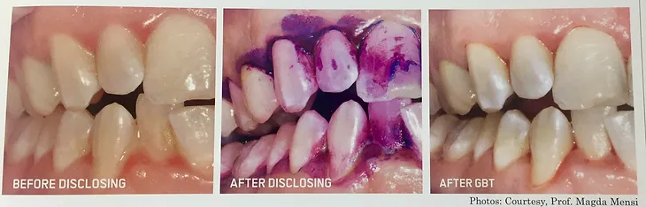 Gingivitis | Brisbane, QLD | Carina Dental Practice Gingivitis | Brisbane, QLD | Carina Dental Practice