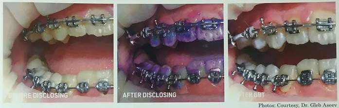 Orthodontics | Brisbane, QLD | Carina Dental Practice Orthodontics | Brisbane, QLD | Carina Dental Practice