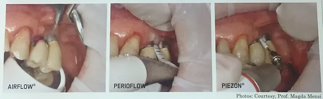 Peri-Implantitis | Brisbane, QLD | Carina Dental Practice Peri-Implantitis | Brisbane, QLD | Carina Dental Practice