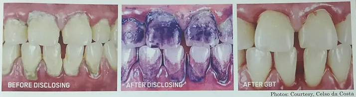 Periodontis | Brisbane, QLD | Carina Dental Practice Periodontis | Brisbane, QLD | Carina Dental Practice
