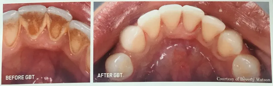 Stains and Calculus | Brisbane, QLD | Carina Dental Practice Stains and Calculus | Brisbane, QLD | Carina Dental Practice