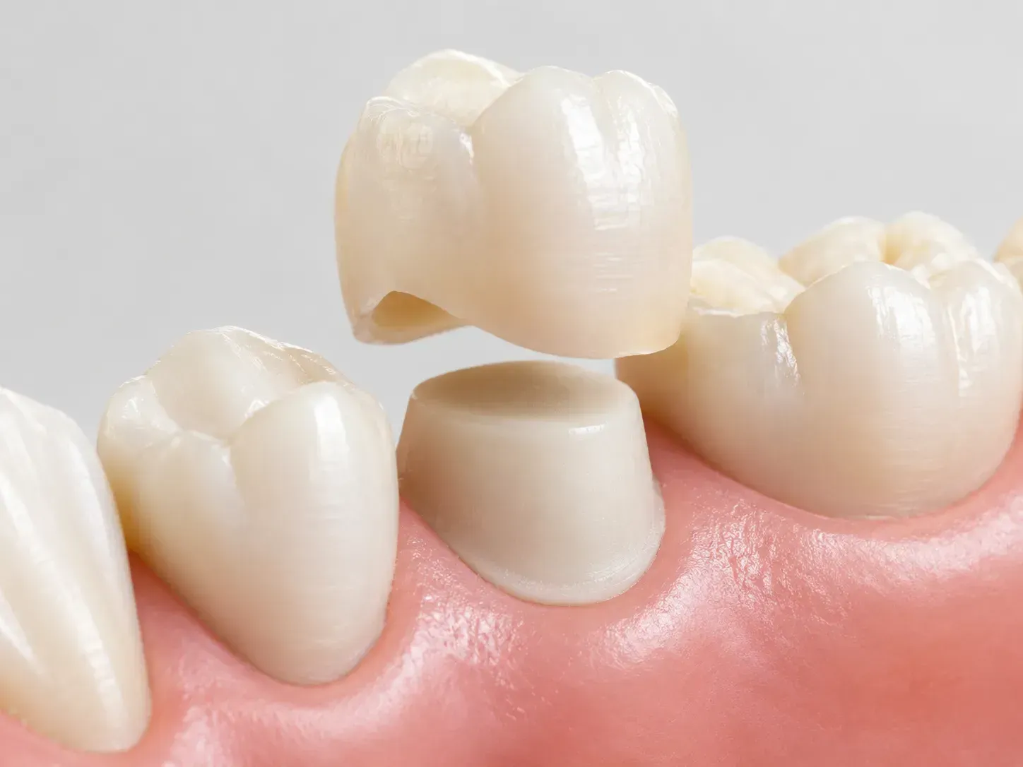 Dental bridge on pink gums with missing tooth gap
