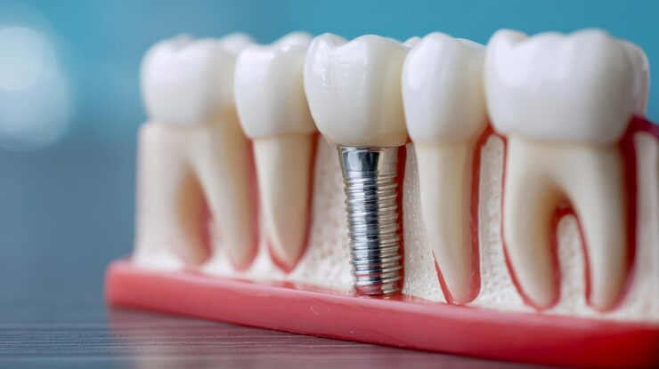 Dental implant model with white teeth and a silver implant in pink gum tissue