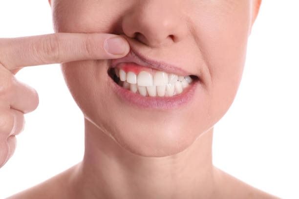 Finger pulling up upper lip to reveal teeth in a close-up smile