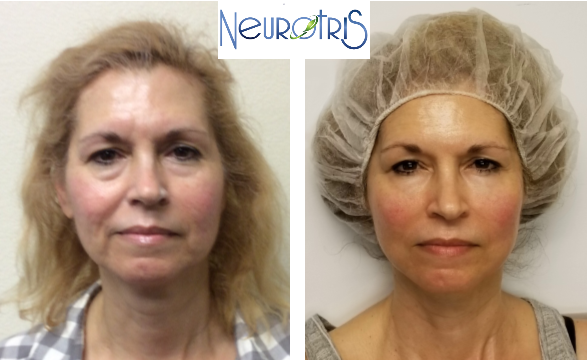 Before-and-after chin lift comparison, woman's neck showing improved definition after one session of Cryo One treatment.