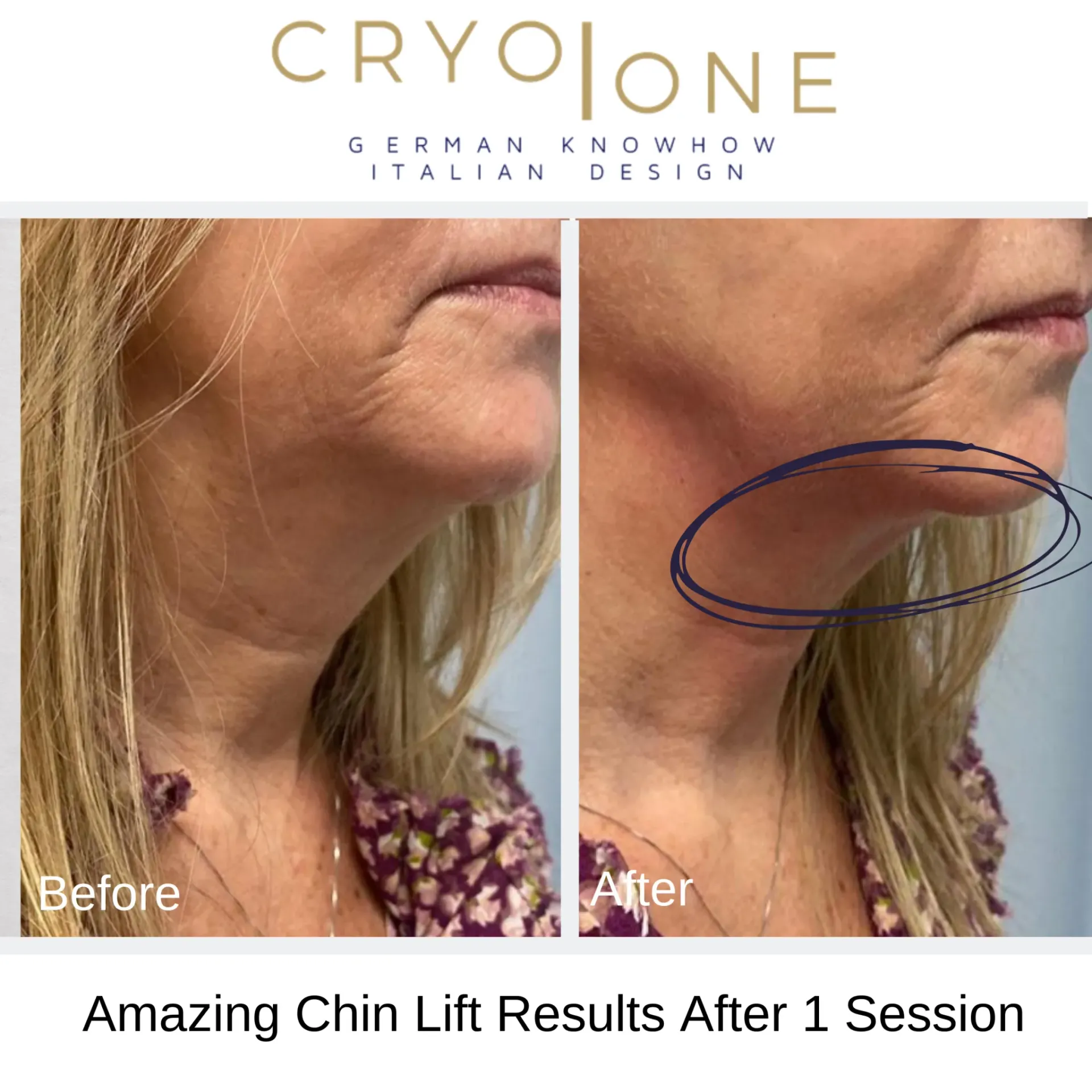 Before-and-after chin lift comparison, woman's neck showing improved definition after one session of Cryo One treatment.