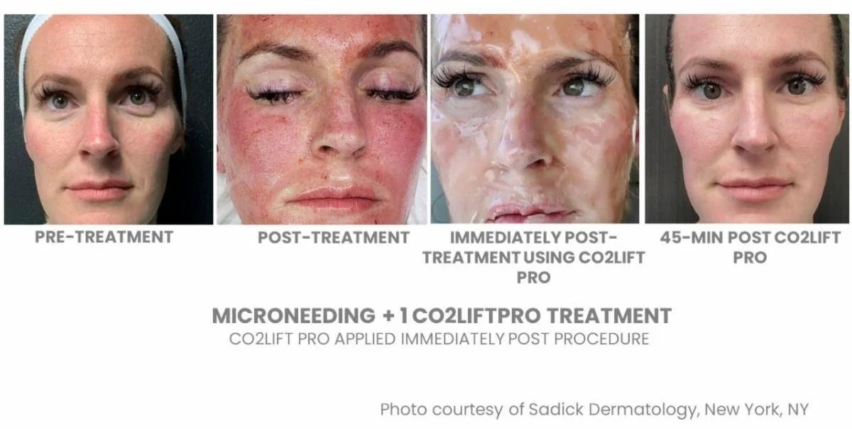 Woman's face before and after microneedling + CO2Lift Pro treatment. Redness, then improved appearance.