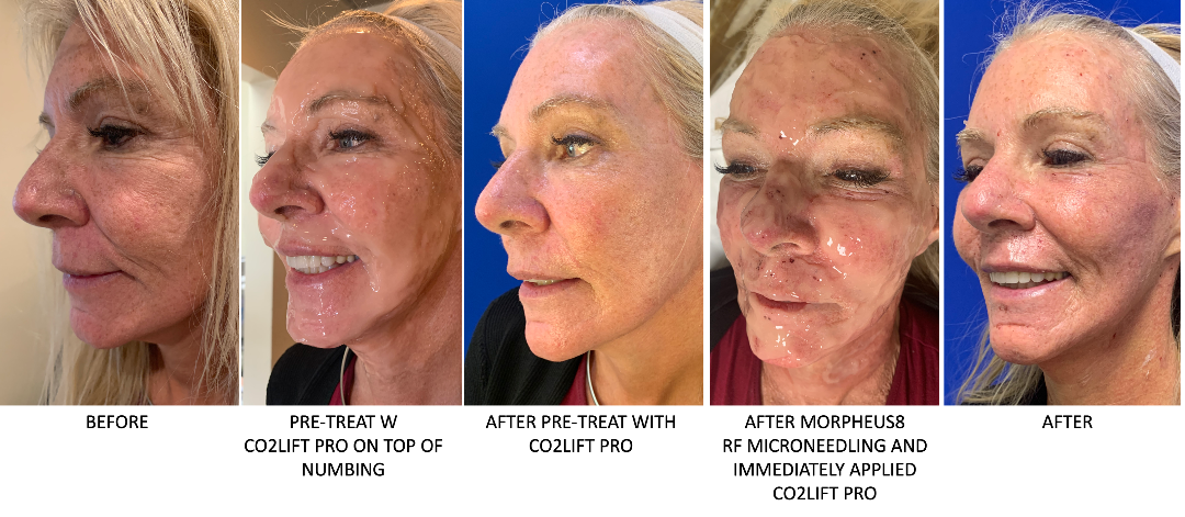 Woman's face profile before, during, and after treatment, showing changes to skin.