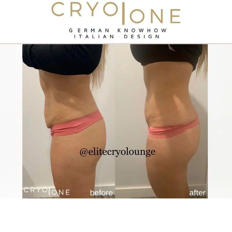 Side-by-side photos of a woman's torso, before and after cryotherapy, showing reduced fat and firmer skin.