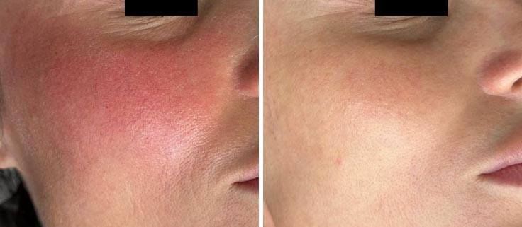A split-screen comparison showing a cheek with significant facial redness on the left and a clearer skin tone on the right.