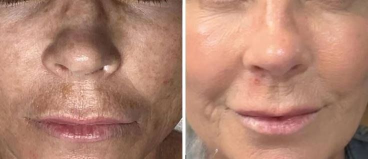 Before and after comparison of a person's lower face showing reduced skin hyperpigmentation and improved skin texture.