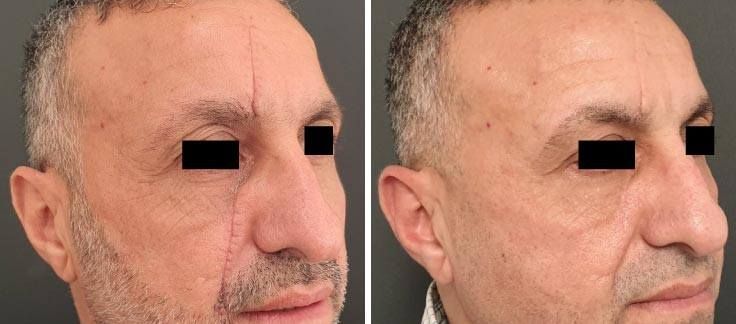 Before and after comparison of a patient’s profile showing a facial surgical scar and its subsequent aesthetic improvement.