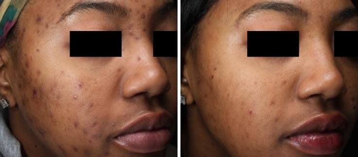 Before and after comparison showing reduced acne and hyperpigmentation on a person's face.
