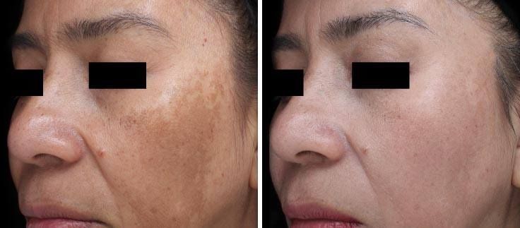Before-and-after comparison showing the reduction of facial hyperpigmentation, such as melasma, on a person’s cheek.